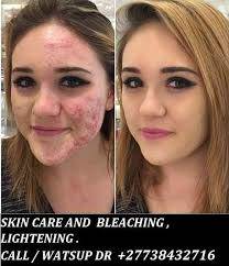 Permanent Skin Lightening Skin Whitening Products +27738432716  