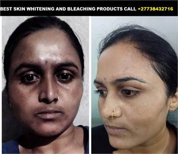 Permanent Skin Lightening Skin Whitening Products +27738432716